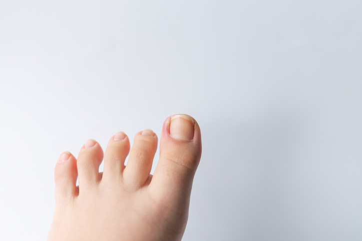 1分でできる巻き爪セルフチェック